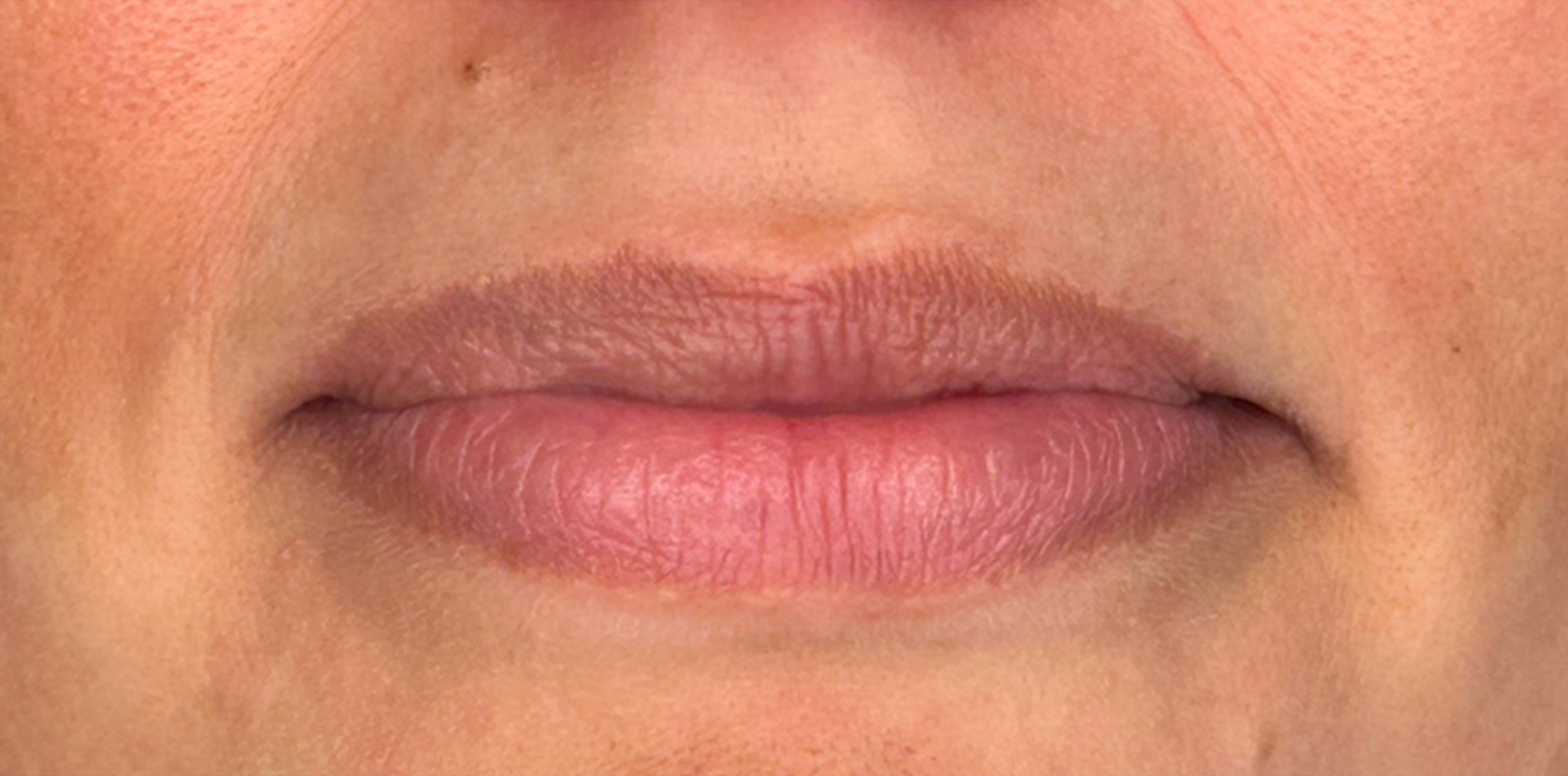 Foto Rejuv. Laser Antes 1