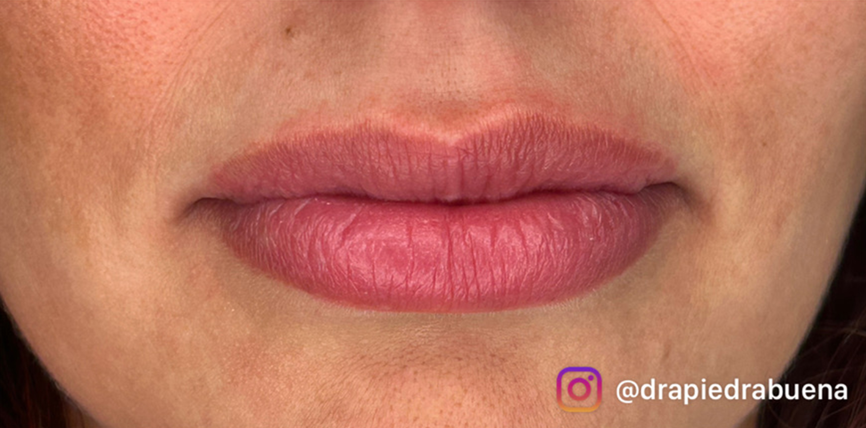 Foto Rejuv. Laser Despues 1