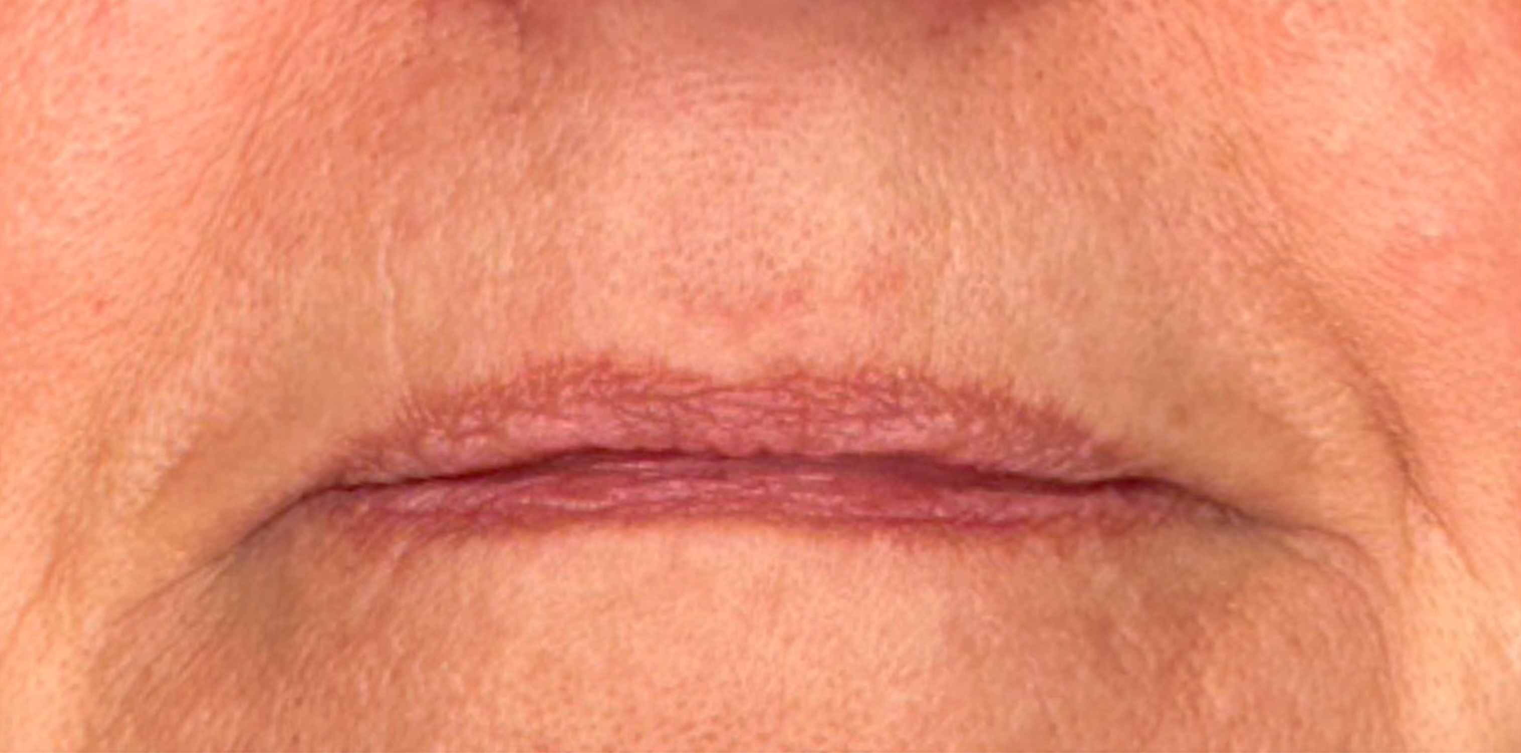 Foto Rejuv. Laser Antes 3