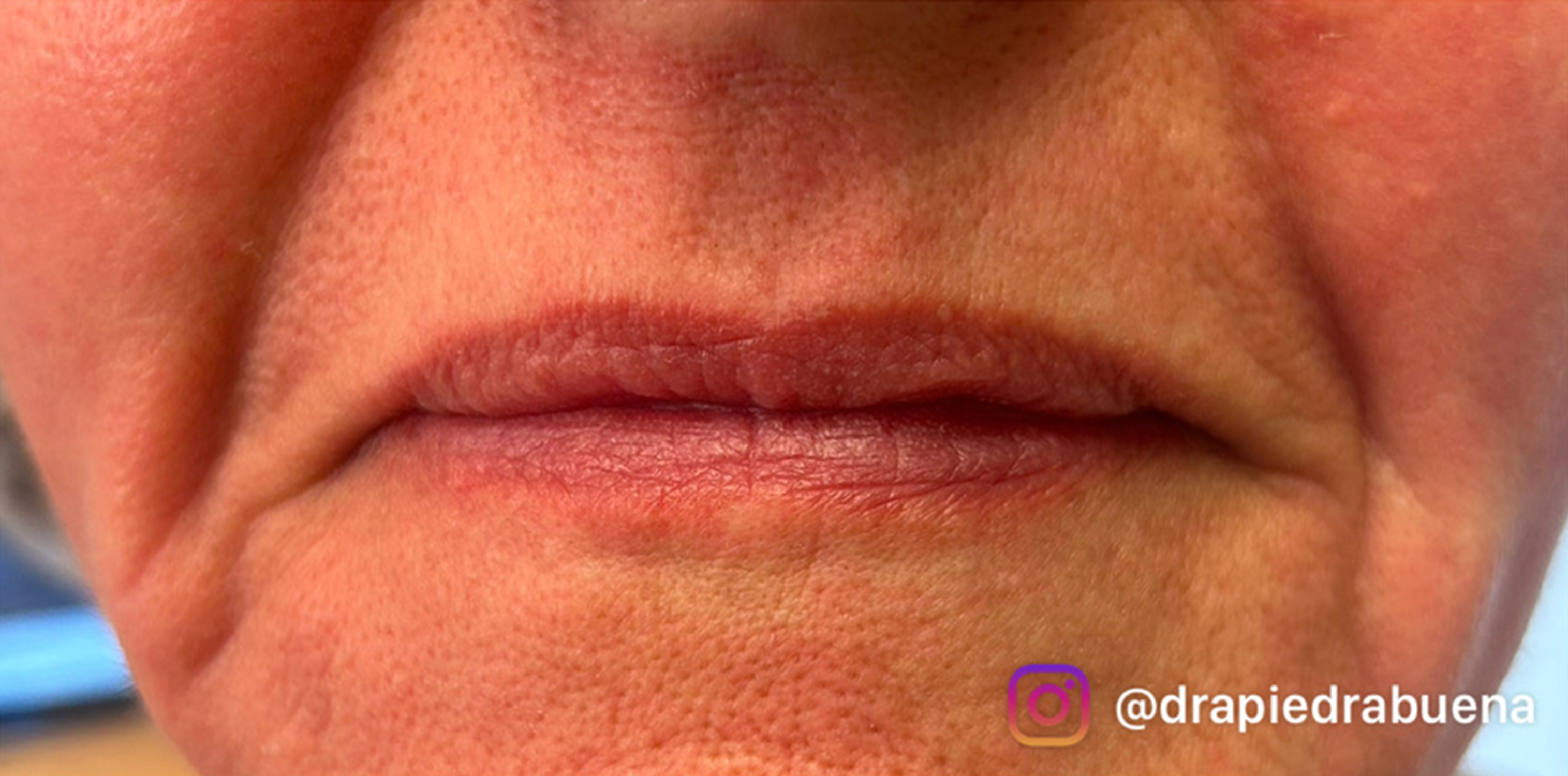 Foto Rejuv. Laser Despues 3